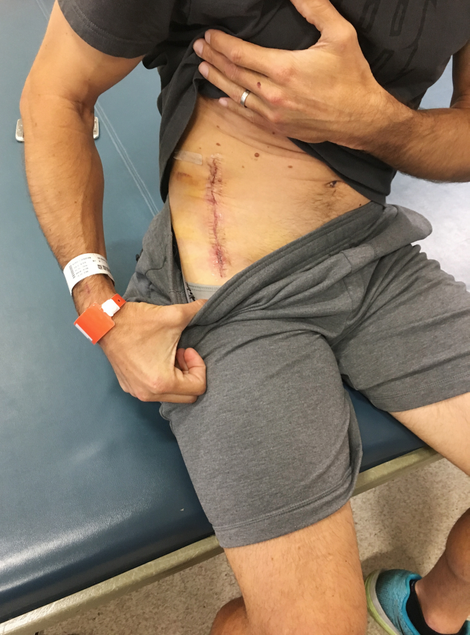 Bourdais’ big scar from the surgery, taken shortly after he was released from the hospital. Photo credit: Jenna Fryer/AP Images